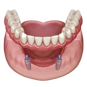 Protocolo Overdenture
