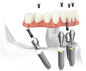 Posição dos Implantes no All-on-Four