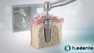 Cirurgia guiada de implante dentário com guia cirúrgico impresso em 3D - H. Odonto