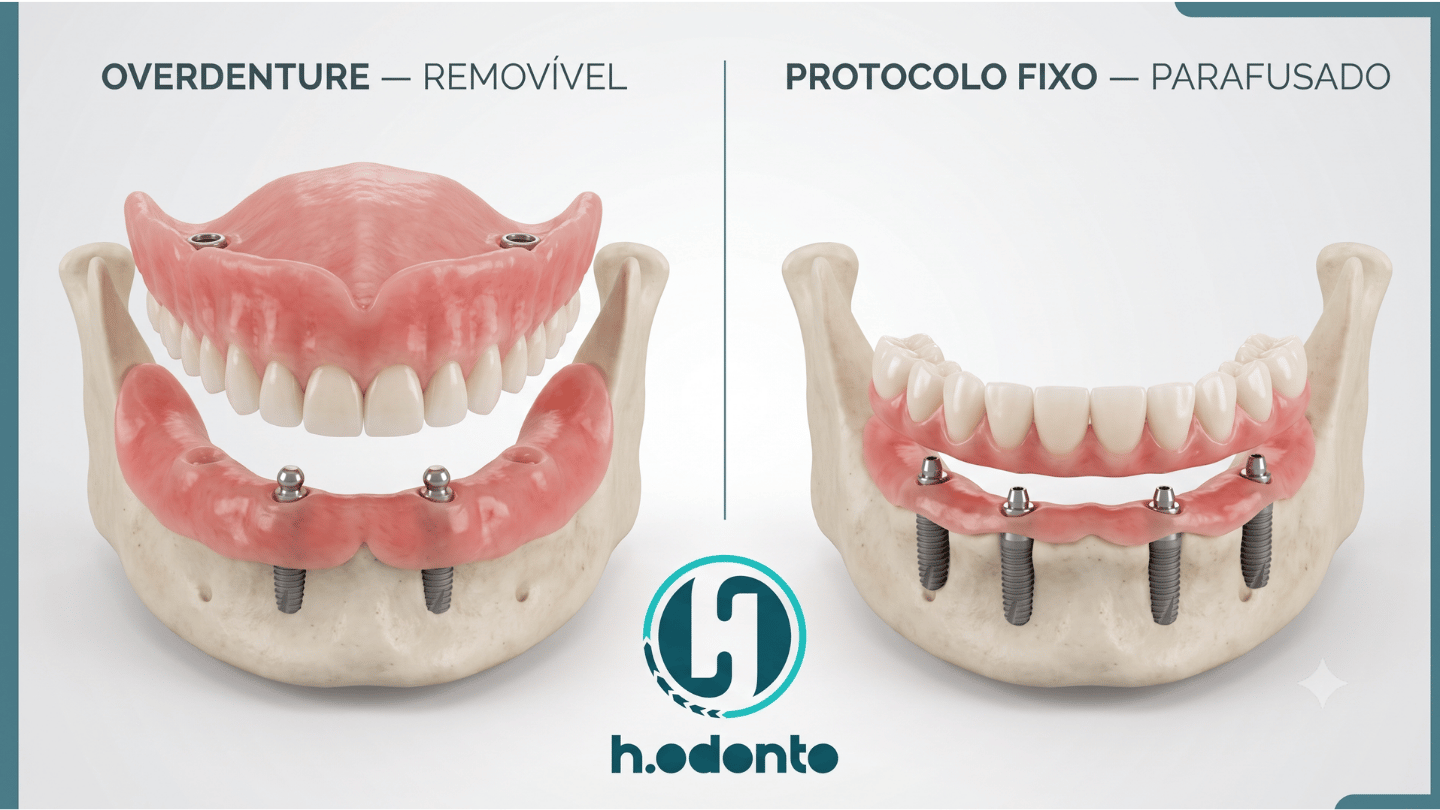 Comparação entre overdenture removível e protocolo fixo sobre implantes
