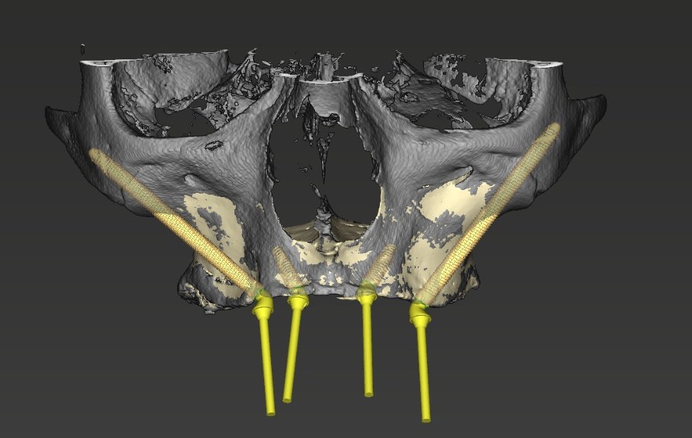 Planejamento digital em 3D de implantes zigomáticos