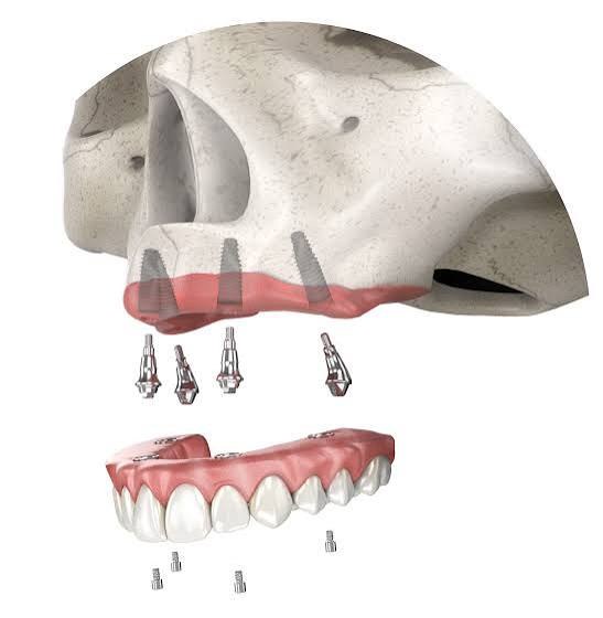 Ilustração de protocolo All-on-Four: prótese fixa sobre 4 implantes